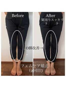 ルナグレイス(LUNA GRACE)/フェムケア矯正施術前後比較