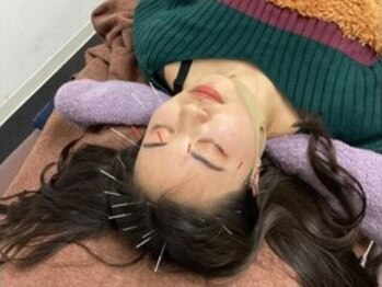ブライト鍼灸整体院(Bright鍼灸整体院)の写真/【眼精疲労、頭痛解消はお任せ下さい】頭皮鍼＋ヘッドスパで脳疲労へもアプローチ！心と体をリフレッシュ♪