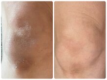 ヒメミ(Himemi)/ローマピンク　ひざ