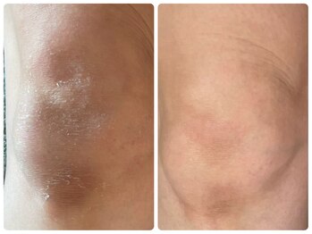 ヒメミ(Himemi)/ローマピンク ひざ