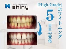 ホワイトニングサロン シャイニー 浜松細島店(shiny)/【超絶・美・白】ホワイトニング