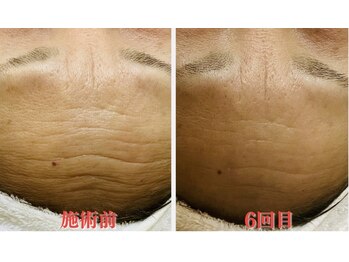 クイーン(QUEEN)/光フォト+ハーブピーリング