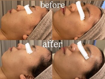 フォー(For...)/韓国発!高密度超音波◇赤み/保湿