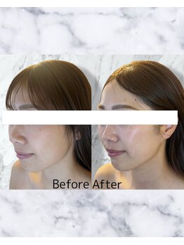 ルミライ(Lumirai)/たるみ改善|毛穴|フェイシャル