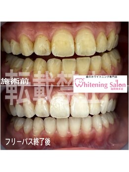 ホワイトニングサロン 福岡博多店/ホワイトニング