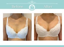美人バスト 北千住店/【バストアップ★育乳】症例