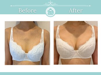 美人バスト 北千住店/【バストアップ★育乳】症例