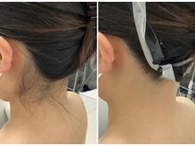 メディカルサロンドオフ 堺東店(medical salon de off)/うなじ脱毛♪