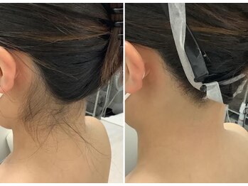メディカルサロンドオフ 堺東店(medical salon de off)/うなじ脱毛♪
