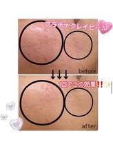 メリア(MeLiA)/どんな肌も赤ちゃん肌へ導く♪