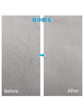 ルアナ(Luana)/ムダ毛なくしてキレイな肌に♪