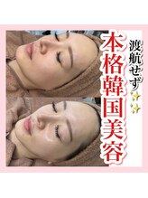 ホワイトアクア 姫路店(WHITE AQUA)/ララピール/姫路/美白/透明感