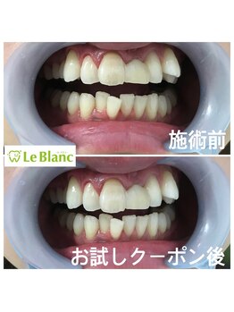 ルブラン 奈良店(Le Blanc)/ホワイトニングのメリットは？