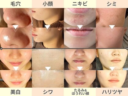 ルディラ医療提携エステ 恵比寿店 毛穴/小顔/ニキビ・シミ・美白・シワ・たるみケアの写真