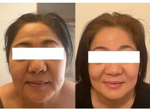 ルポ 那覇(repos)/リフトアップ特化美容鍼