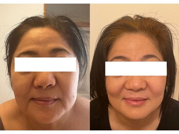 ルポ 那覇(repos)/リフトアップ特化美容鍼