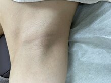 ナノハナ/鹿沼市の全身脱毛美容室ナノハナ