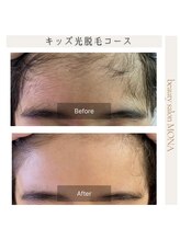 モナ 宝塚店(Mona)/毛のお悩みを持つお子様も対応可