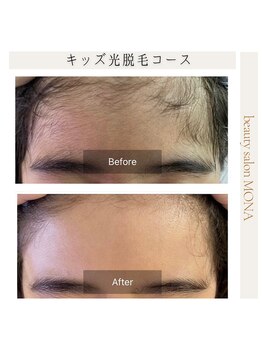 モナ 宝塚店(Mona)/毛のお悩みを持つお子様も対応可
