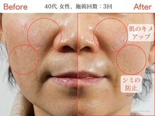 プリュボーテ(Pul Beaute)/話題のララピール♪