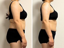 リンド(Lindo)/筋膜リリース