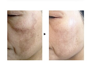 ビューティーガーデン(Beauty Garden)/シミケア