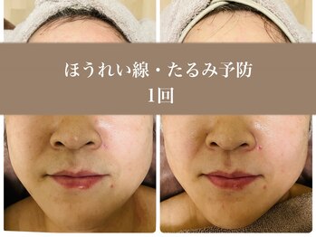 ムク(MUKU 無垢)/ほうれい線・たるみ改善