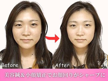 鍼灸整体院ワト 三軒茶屋院(鍼灸整体院WATO)/■1番人気の美容鍼&小顔矯正