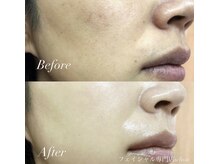 シェーン(Schon)/乳酸ピーリング