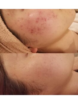 マーリィズエステティック(MARLEY'S AESTHETIC)/漢方ハーブピーリング