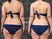 レナータ 新宿店(RENATA)の雰囲気（【脂肪冷却】Before・After◎ダイエット・新宿・六本木・池袋）
