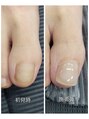 エヌ(enu.)&nbsp;巻き爪ケア