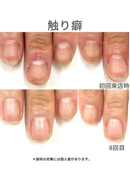 50代/触り癖/3ヶ月後アフター