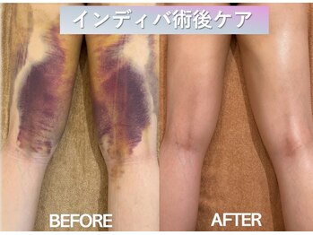 ラディアント(Radiant)/インディバ術後ケア/肌質改善