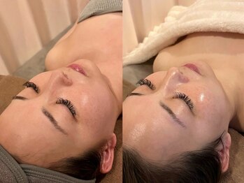 ビクシー(Bixie)の写真/【NEW★】韓国で話題!シワに特化した大人の次世代ピーリング《ラミピール》で憧れの水光肌へ♪