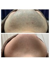 アンジェリーナ/30代/ヒゲ脱毛/6回