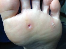 ドクターネイル爪革命 秋津店/たこ・うおのめ改善しませんか？