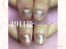 ツリートップ(Tree Top)/深爪矯正