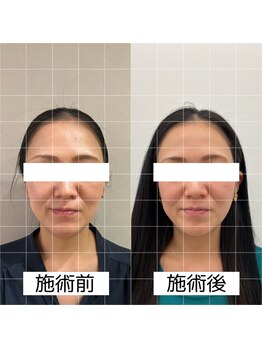 ヴィーライン 大阪梅田院(VeLine)/鍼灸／美容鍼／小顔／大阪／梅田