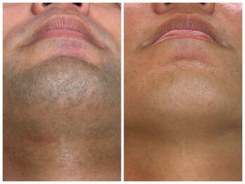 フェリス(FELIZ)/メンズ脱毛人気No.1