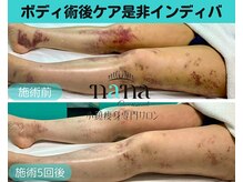 ナナ 銀座(Nana)/脂肪後のダウンタイムお悩みの方
