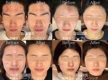 いじり鍼灸整体院の雰囲気（フェイスハーブピーリング☆Before /After◎毛穴,ニキビケアに！）