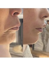 エクラ 五反田(eclat)/瞬間リフトアップフェイシャル