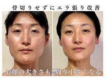 スロウ(SLOW.)の雰囲気（エラ張りは削らなくてもここまで変わる。顔の大きさも激変！）