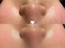 毛穴・ニキビ・シミ・保湿などの肌質改善から、小顔・たるみ・フェイスラインなどの深層ケアもトータル対応
