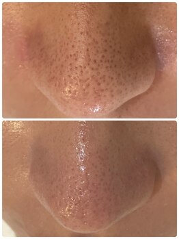 ル シェリア(Le Cherien)/毛穴洗浄Before after