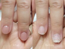 ミンスネイル(Mins Nail)/深爪矯正before&after