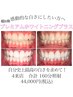 ☆プレミアムセルフホワイトニングプラスコース☆【4来店メニュー】