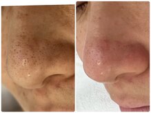 エースマイルイズ(A smile is..)/毛穴ケアフェイシャル