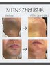 ◆メンズヒゲ脱毛◆¥3500